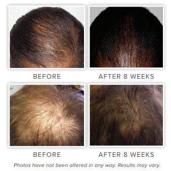 Hair Thickening Serum by NeoGenesis